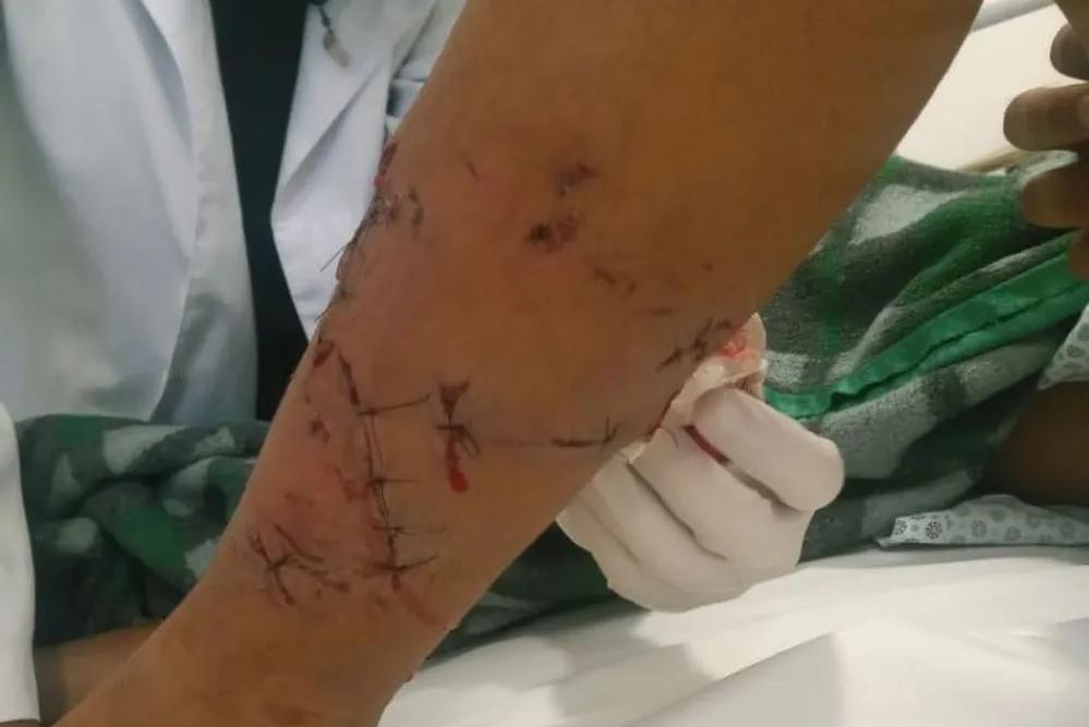 Menino de 11 anos é atacado por pitbull, que escapou de casa e acabou morto pela população