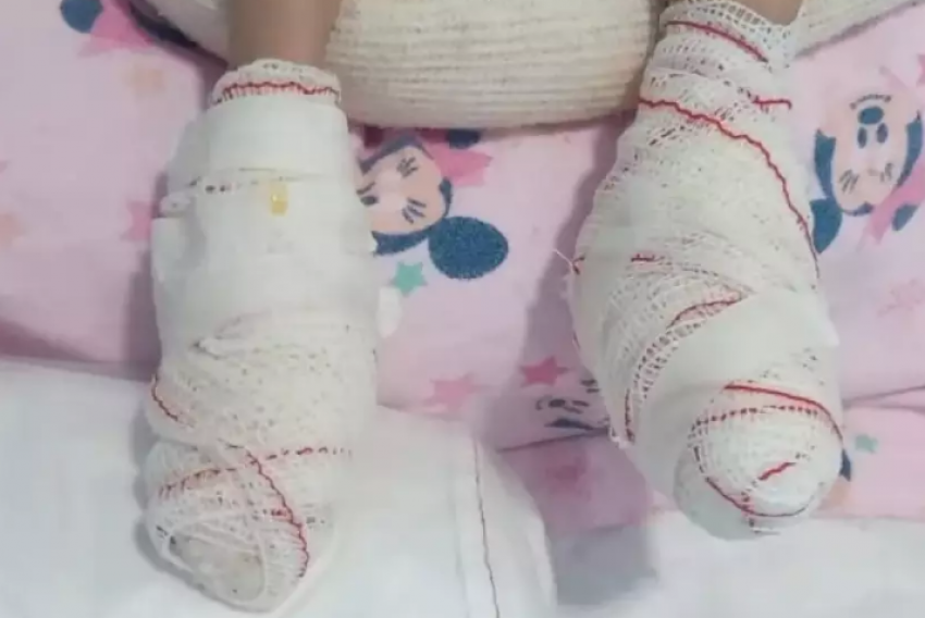 Morre bebê que teve pé queimado em hospital de Jacareí