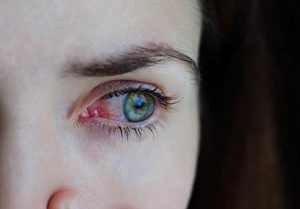 Gripe e resfriado aumentam casos de conjuntivite