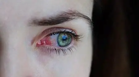 Gripe e resfriado aumentam casos de conjuntivite